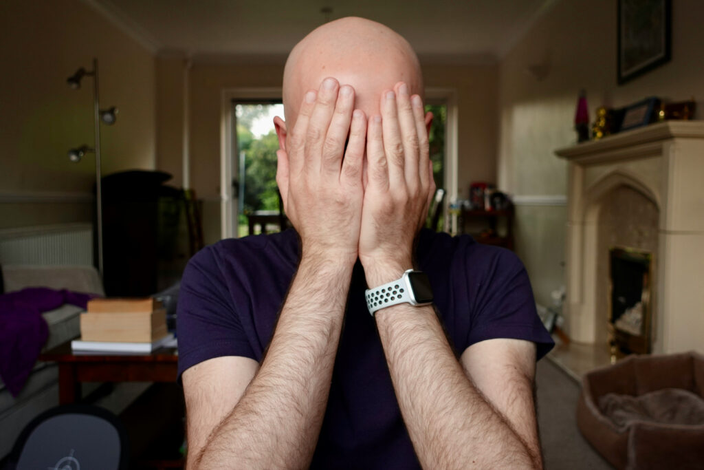 How Fast Does Male Pattern Baldness Progress? What to Expect